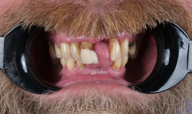 Dental Implants