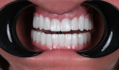 Dental Implants
