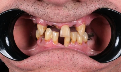 Dental Implants