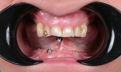 Dental Implants