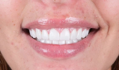 Hollywood Smile
