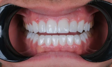 Hollywood Smile