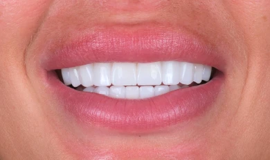 Hollywood Smile