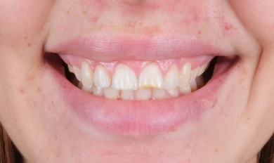 Hollywood Smile