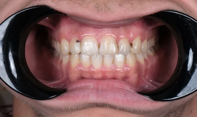 Hollywood Smile