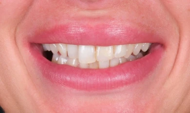 Hollywood Smile