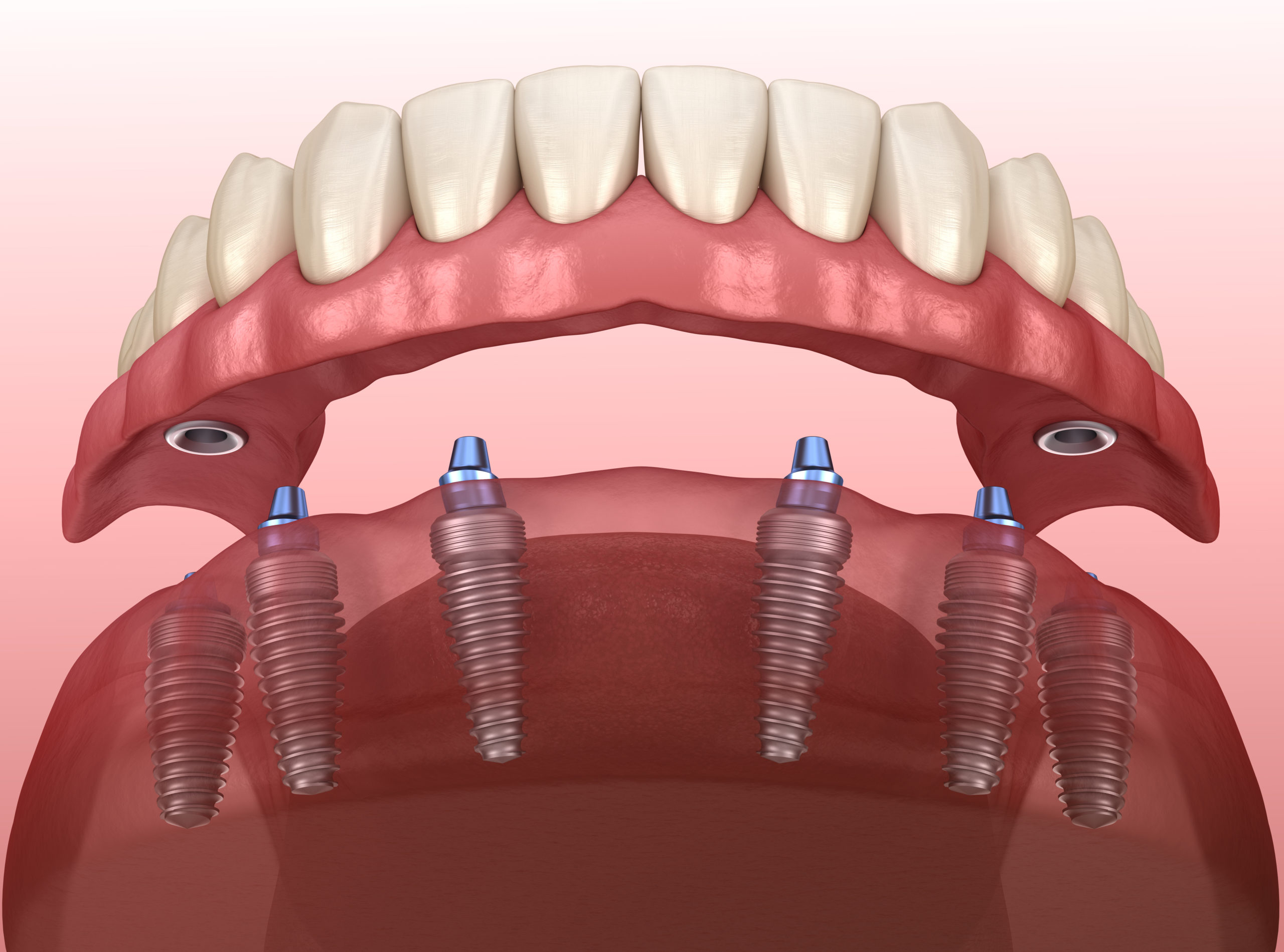 full mouth dental implant